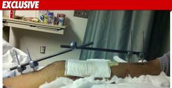 'Camp Rock 2' Star -- I SNAPPED My Shin Bones
