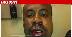 Cedric Benson's Alleged Beating Victim -- BLOODY Photo