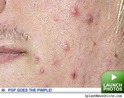 Pop Goes The Pimple -- click to launch