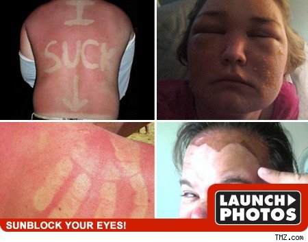 joke sunburn