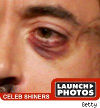 Hugh Laurie Took a Shot to the Face Celeb shiners