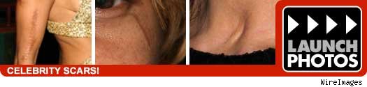 celebrity scars celebrity scars
