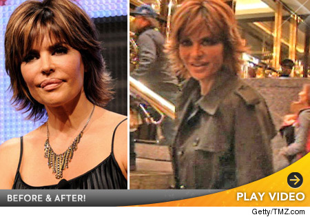 Lisa Rinna lip reduction photos.