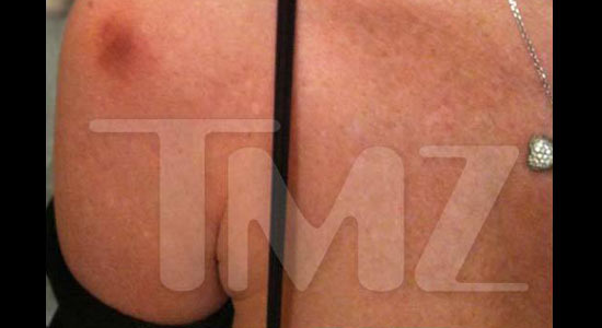 0405_alicia_injury_TMZ