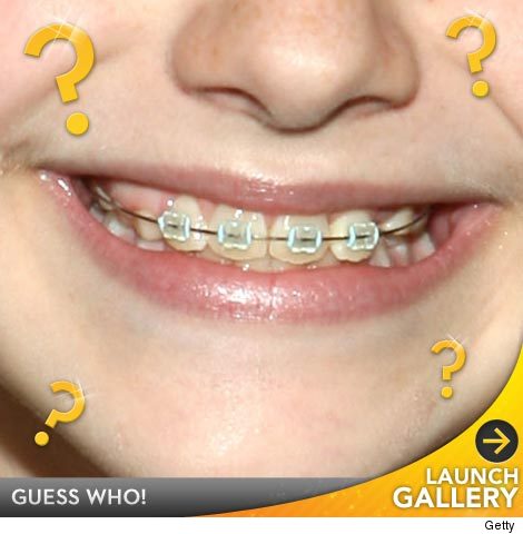 0422_a_braces_launch