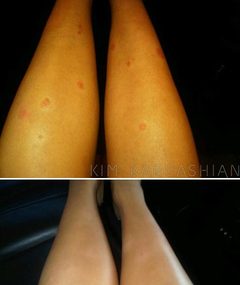 Kim Kardashian Overshare: Psoriasis Before & After Shots!