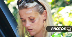Reese Witherspoon -- Big Black Eye After Car Accident