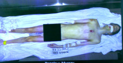 Michael Jackson Autopsy Photo -- Dead, Naked Body [PHOTO]