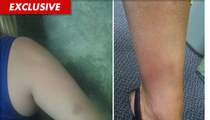 Michael Lohan's Ex -- Bruising Photos after Alleged Domestic Abuse