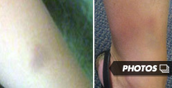 Michael Lohan's Ex -- Bruising Photos after Alleged Domestic Abuse
