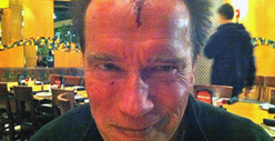 Arnold Schwarzenegger -- Suffers Head Wound on Movie Set
