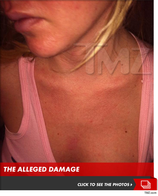 Ashley Mattingly bruised -- abuse photo