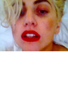 Lady Gaga Tweets Black Eye Photo After Concert Accident!
