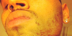 Chris Brown Injured In Bar Fight With Drake's Entourage [Updated with Photos]