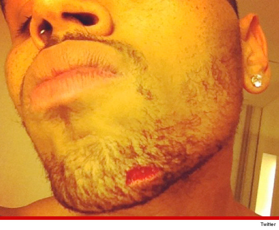 Chris Brown injured & sustained a nasty gash on his chin