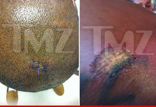 DMX received stiches to his head.
