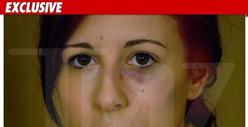 Demi Lovato's Attack Victim -- The Bruising Photos
