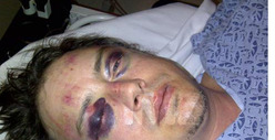 Jason London -- I'm the REAL Victim ... They BROKE My Face [photo]