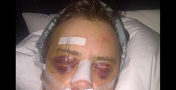 Jason London -- Wanna See My BUSTED Face After Surgery? [Photo]