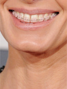 Who Was Wearing Braces on the Grammy Red Carpet?