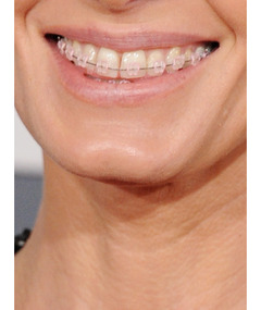 Who Was Wearing Braces on the Grammy Red Carpet?