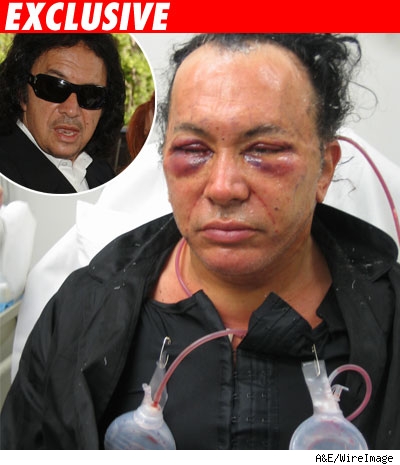 0319_gene_simmons_facelift_-1