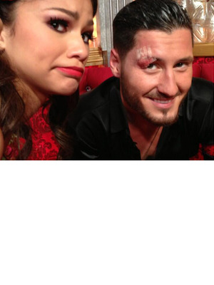 Zendaya Injures Val Chmerkovskiy -- See His Gross Eye Injury!