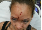 Evelyn Lozada's Bloody Head Gash After Chad Johnson Fight [PHOTOS]