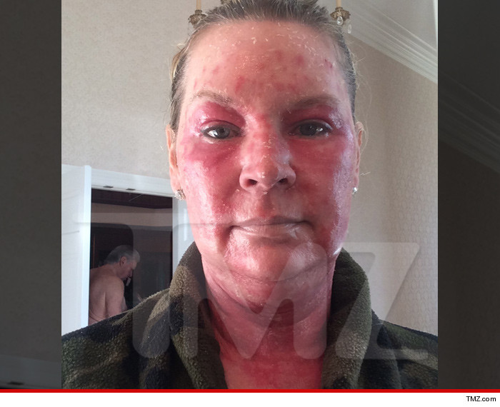 0724-jackie-siegel-burn-face-tmz-01