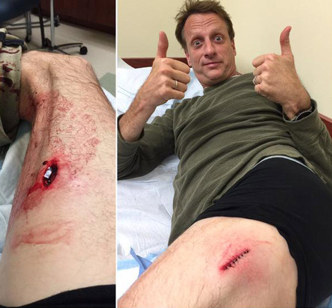 1202-tony-hawk-injury-768-reveal-480w.jpg