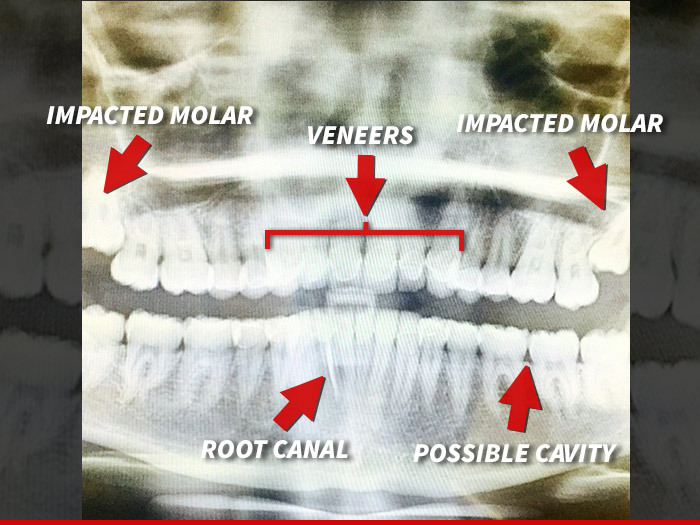 Miley Cyrus -- Gets Yanked by Dentist After Online Tooth Shaming