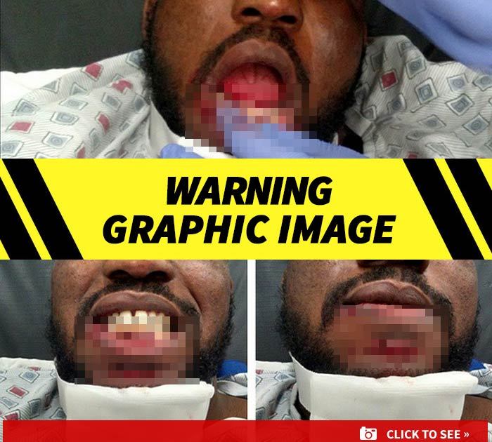 UFC's Corey Anderson -- Teeth Bashed In ... During Insane UFC Fight