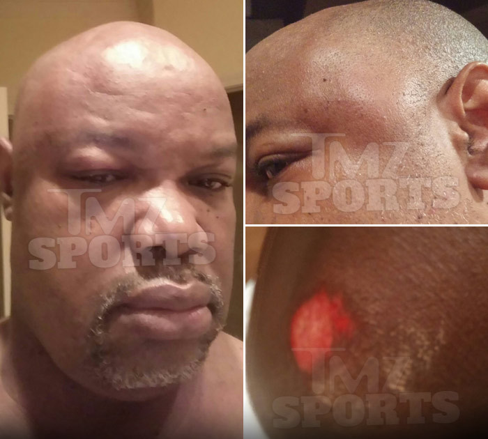College FB Star Laremy Tunsil -- Brutal Post-Fight Pics ... In Alleged Stepdad Attack