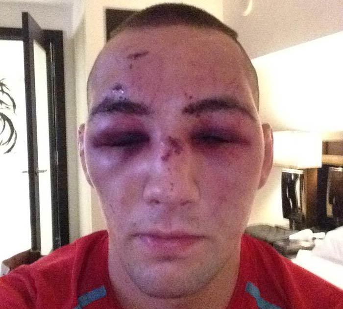 UFC's Rory MacDonald -- Worst Hangover Ever ... Check Out My Broken Face!