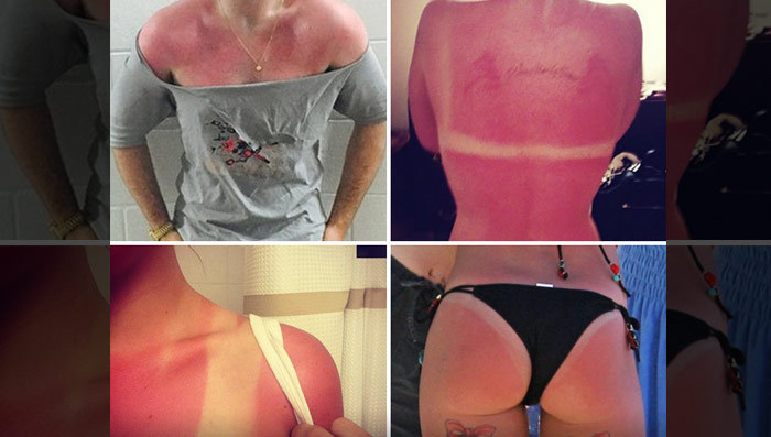Celebrity Sunburns -- Guess Whose Fried Photos!