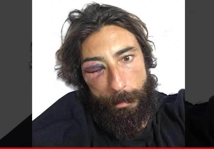 Famous Cyclist Vittoria Brumotti -- Face Bashed in Roadside Attack