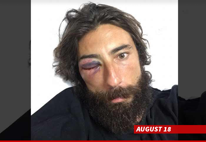 Cyclist Vittorio Brumotti -- Doctors May Remove Eyeball ... After Brutal Attack