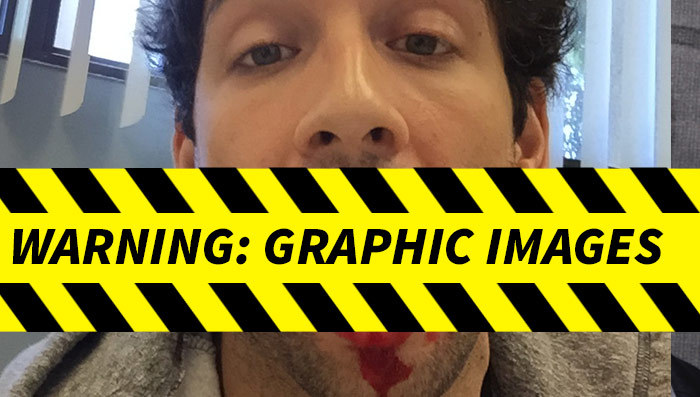 'Undateable' Actor Splits Tongue Open Hours Before Live Show