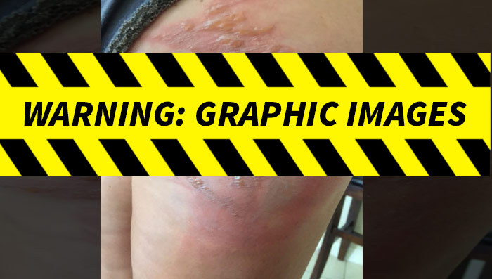 Starbucks -- Customer Flips Her Lid ... Seriously Burned