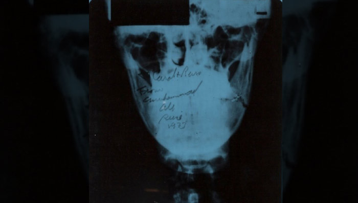 Muhammad Ali -- My Broken Jaw X-Ray ... Rakes In Big Money!