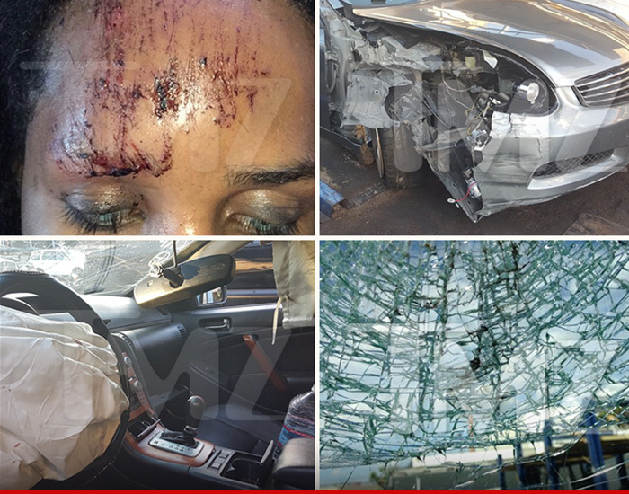 ANTM Contestant -- Bruised And Bloody After Scary Car Wreck