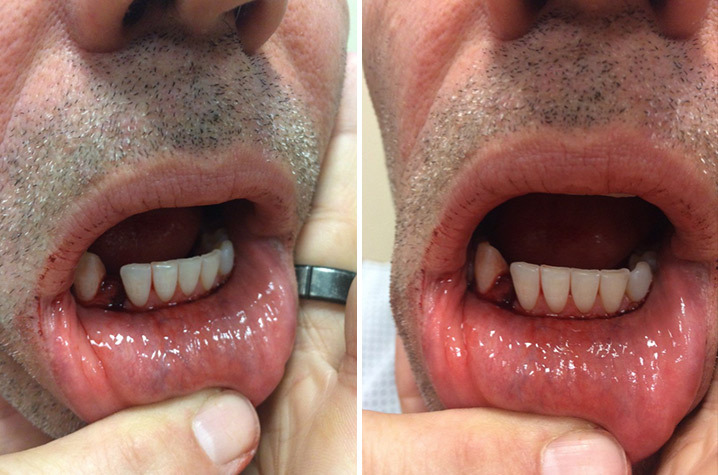 Kurt Warner -- I Cracked My Jaw ... Took Elbow To The Face