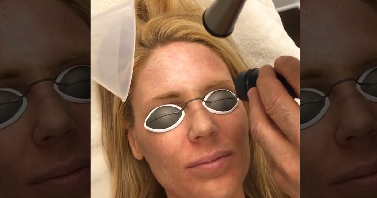 'RHOC' Star Gretchen Rossi -- This Laser Is Like an Eraser to My Face (VIDEO)