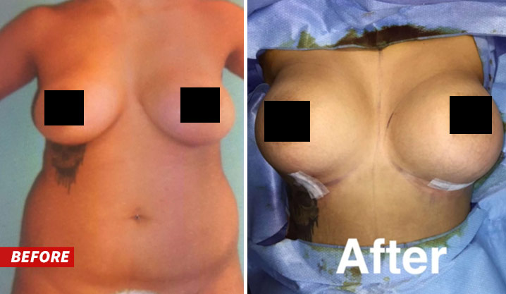 0125-briana-deJesus-butt-lift-SUB-02